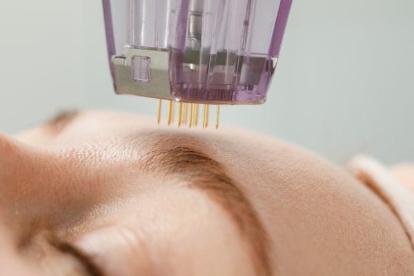 microneedle mesotherapy. woman receiving micro needling rejuvenation treatment in a cosmetology clinic.