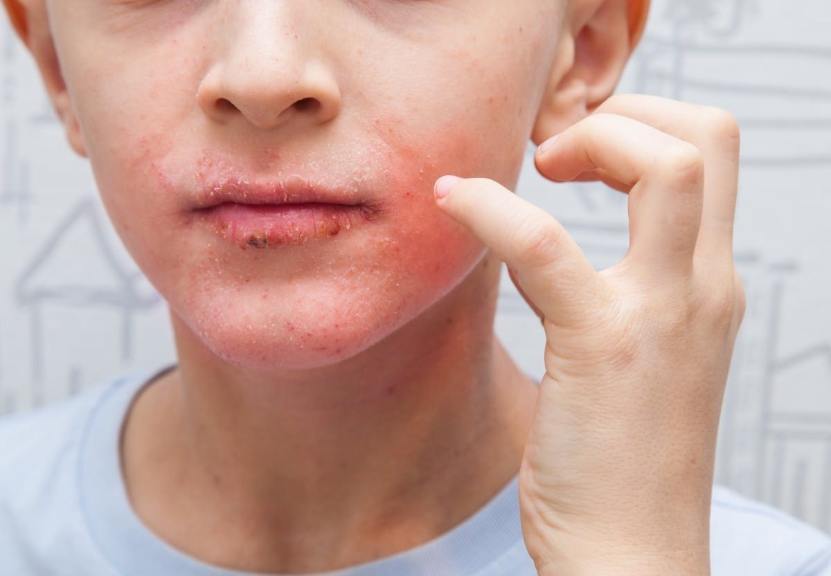 boy scratching his face. human skin, presenting an allergic reaction, allergic rash on face and lips.