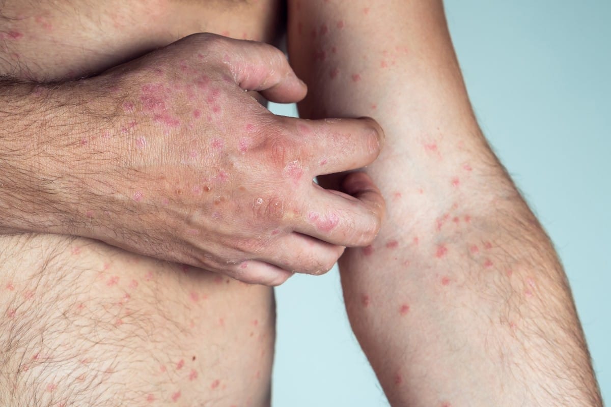 cropped photo of half naked man suffering from psoriasis scratching thick scaly clusters rash on skin of arm. health.