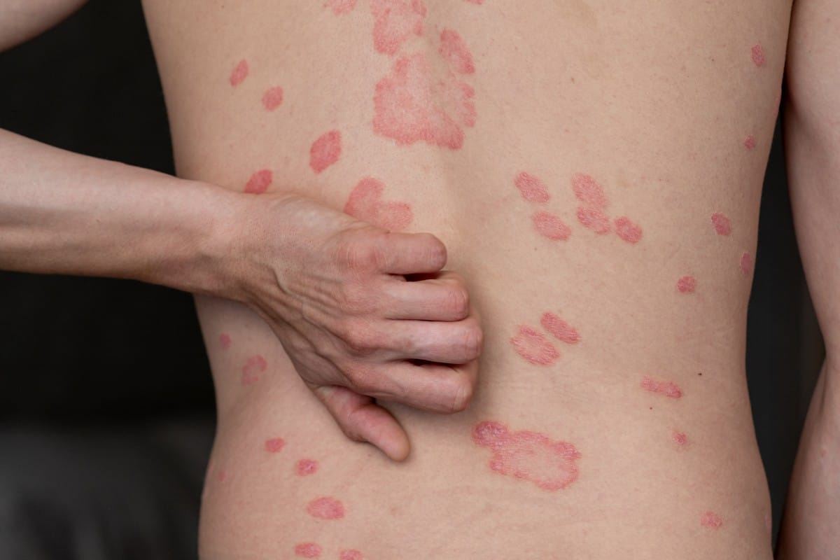 psoriasis vulgaris, skin patches are typically red, itchy, and scaly.