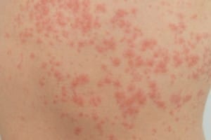 urticaria is an allergic reaction on the skin. red spots on the skin.