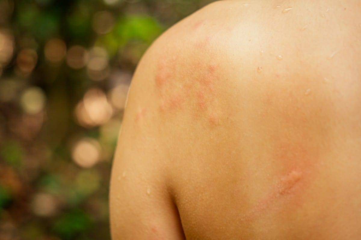 woman with itching from biting insect in body in tropical jungle