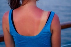 burnt female skin in the sun close up in a blue t shirt