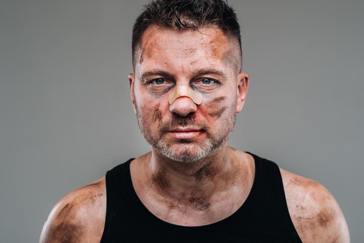 Man with bruised face and bandaged nose