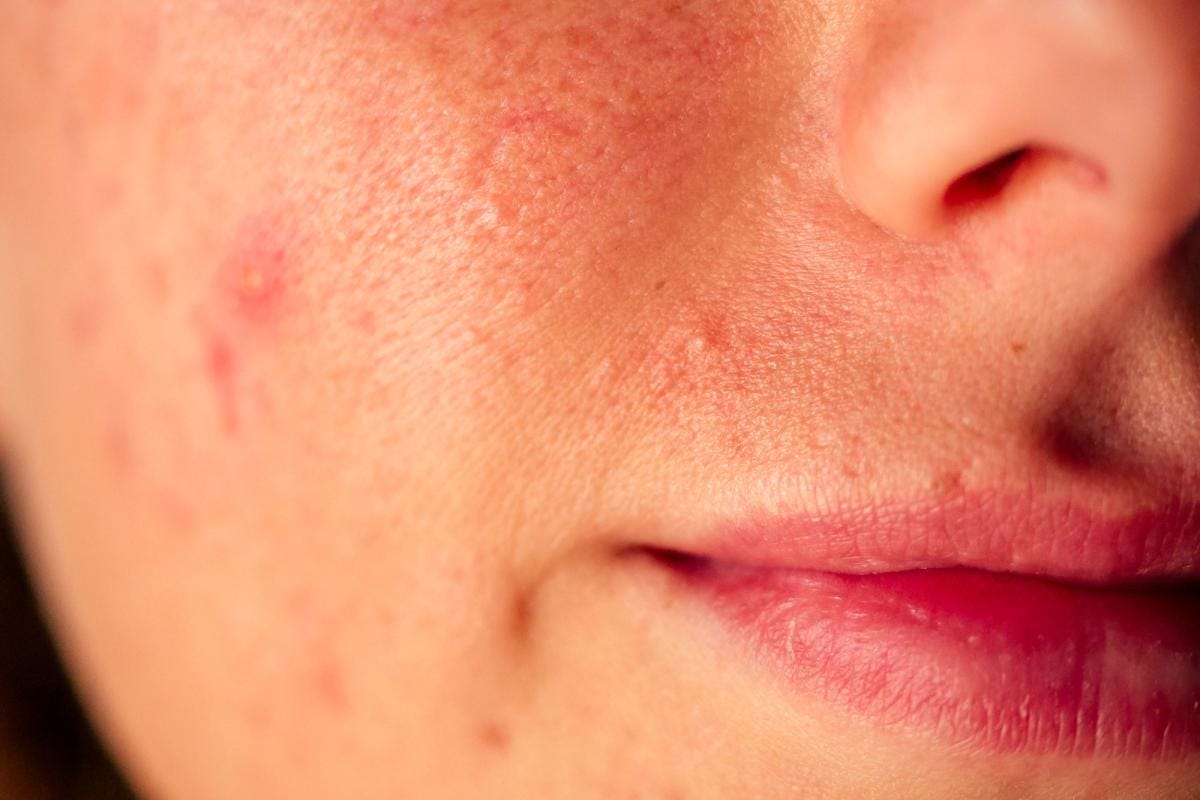 Close-up of person's lower face with acne