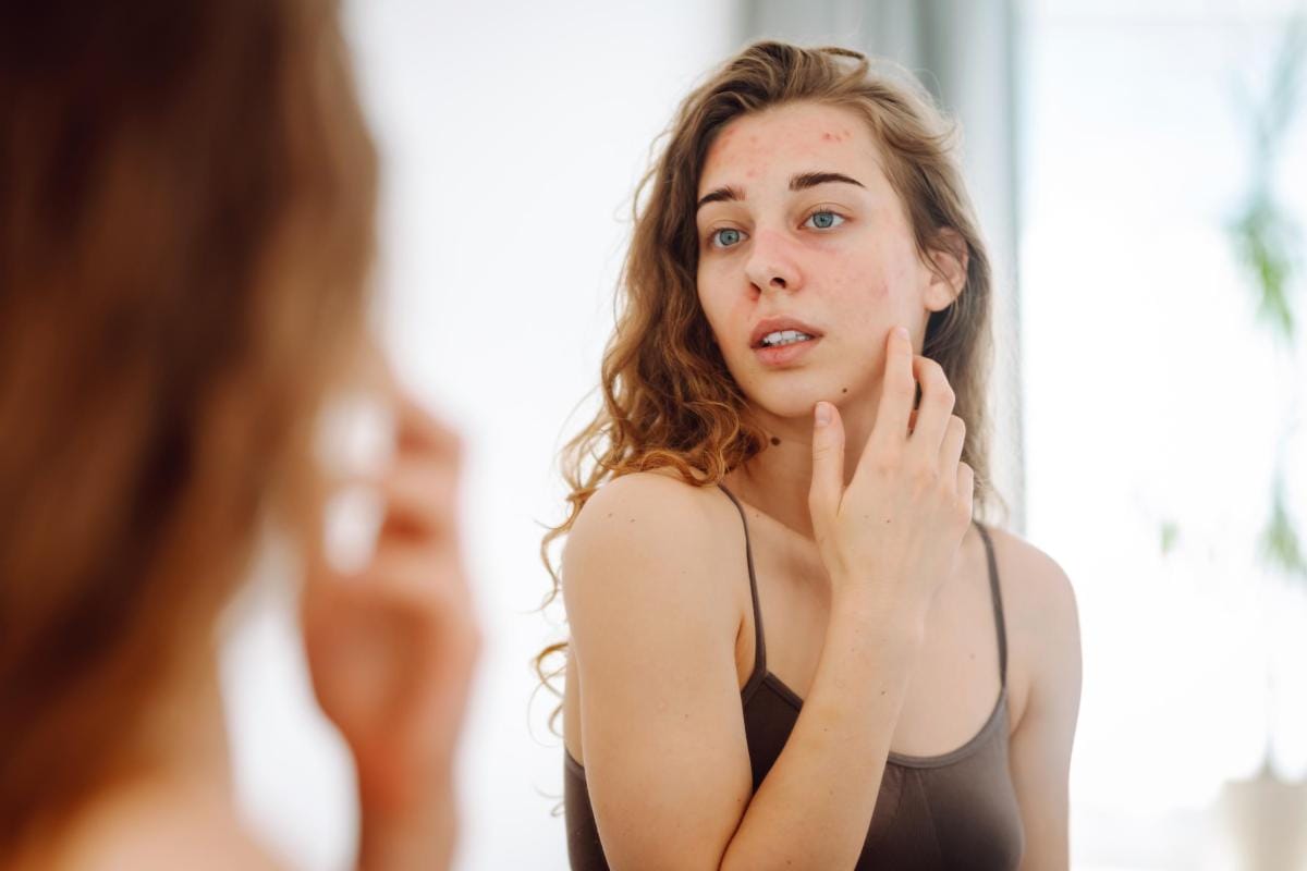 Young woman examining acne in mirror