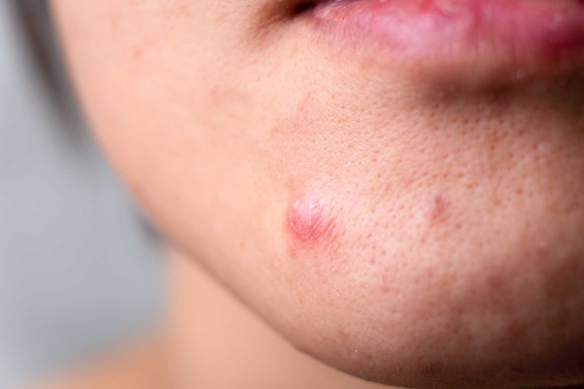 Close-up of pimple on person's cheek