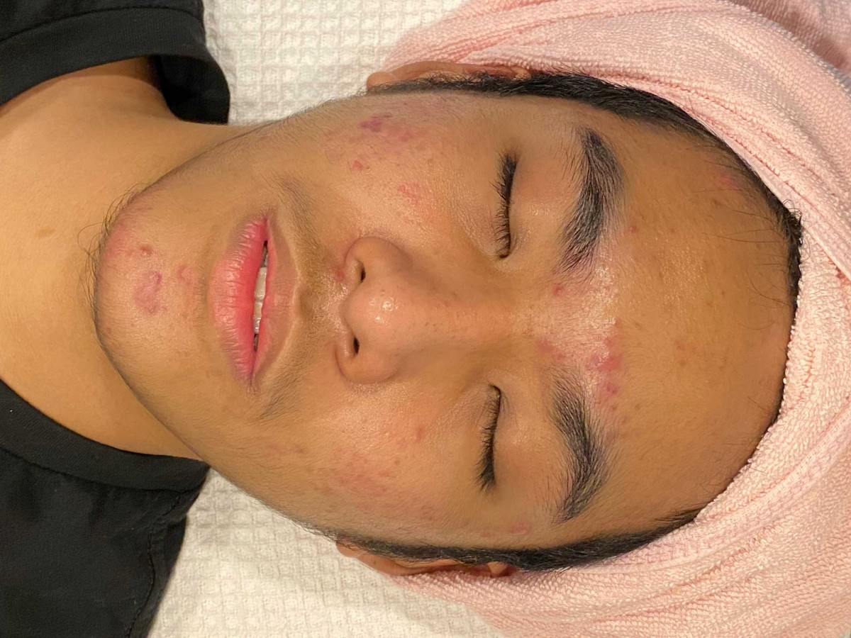 Man receiving facial treatment for acne