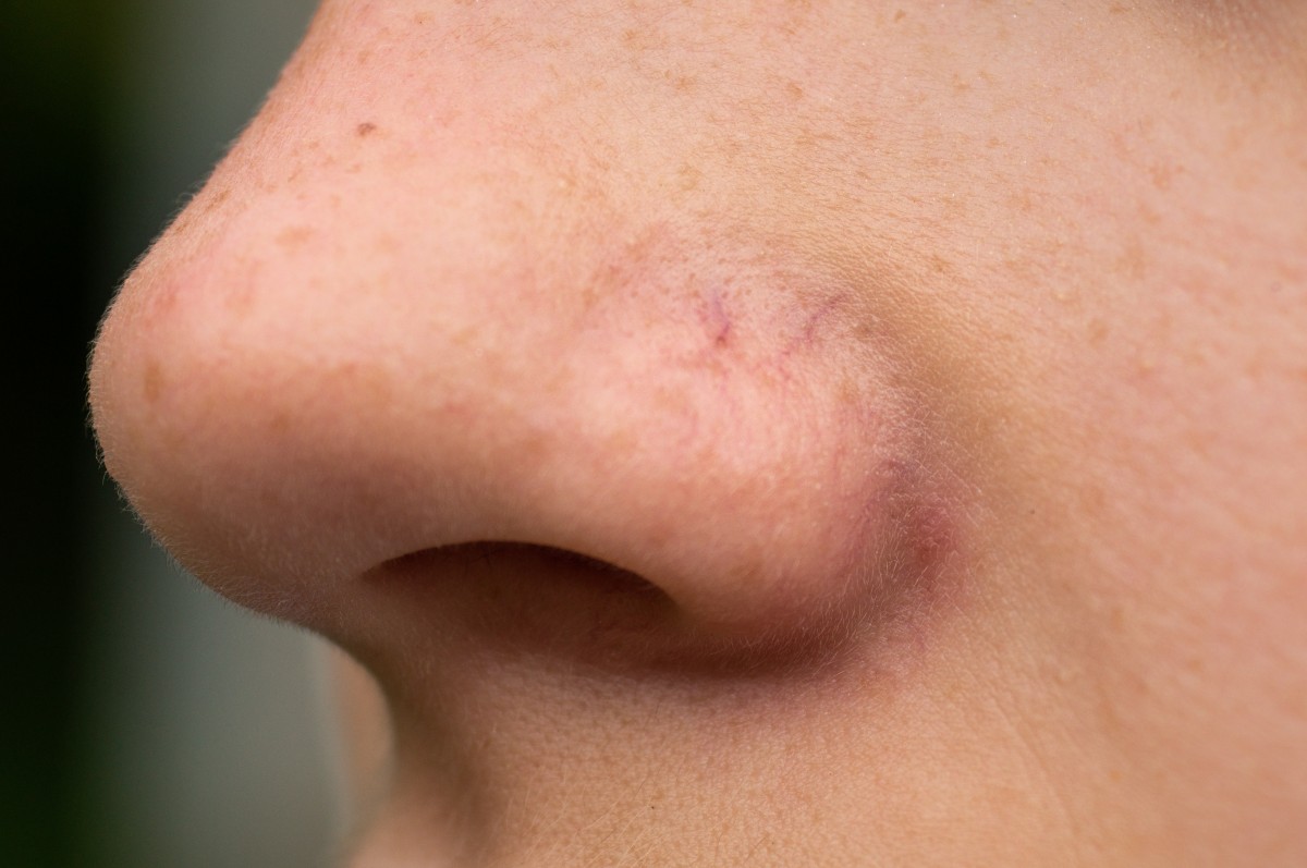 Close-up of nose with visible scar and pores