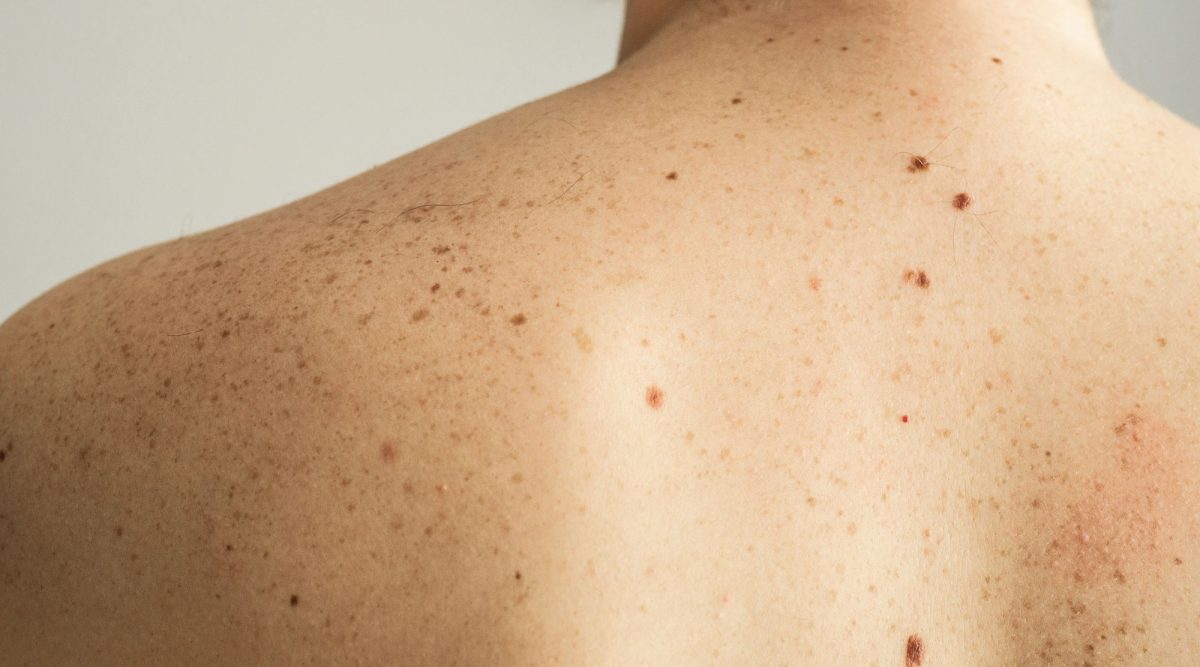 Close-up of human shoulder with freckles and moles